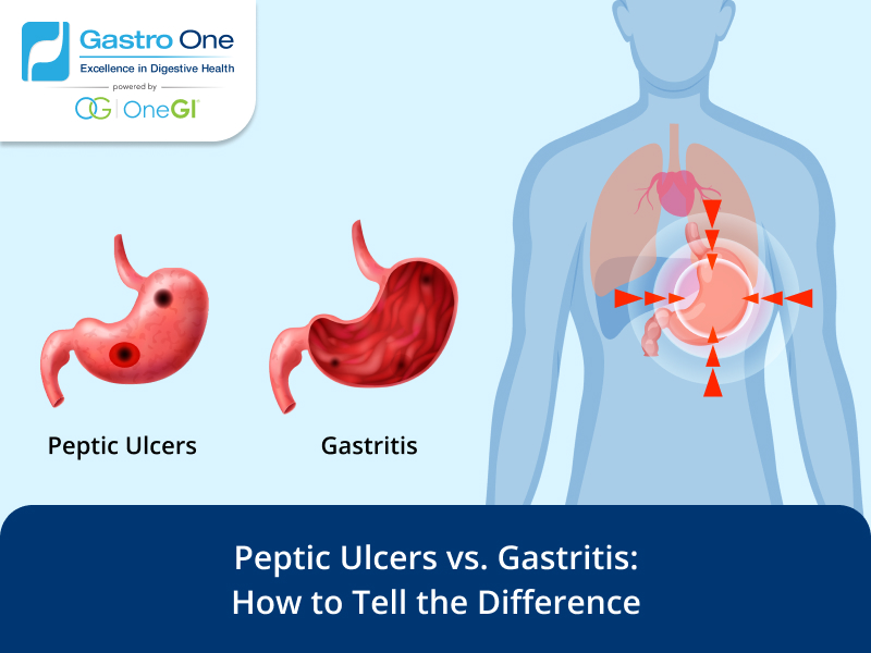 Peptic Ulcers vs. Gastritis: How to Tell the Difference